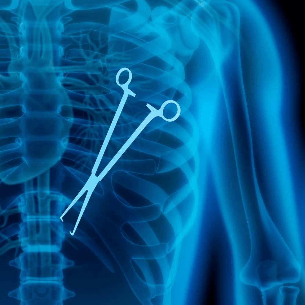 X-ray showing surgical instrument